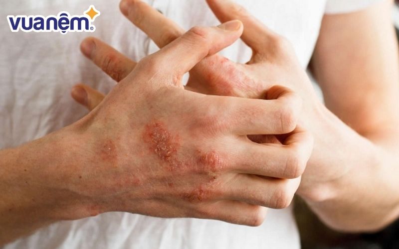 Nằm nệm kém chất lượng có thể gây ra dị ứng