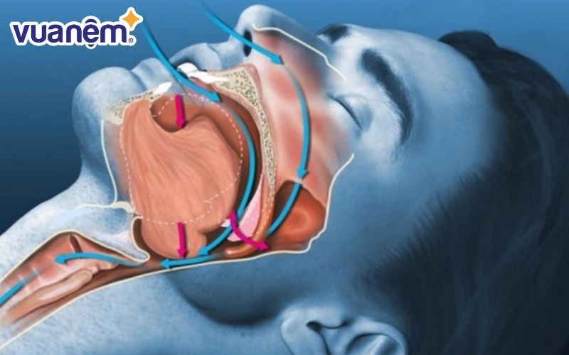 Đường thở bị hẹp có thể dẫn đến tình trạng ngủ ngáy